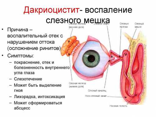 Воспаление слёзного канала: симптомы, причины,