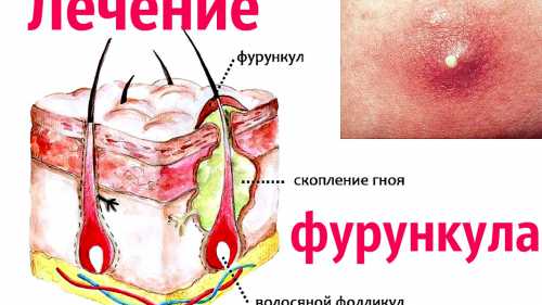 Как лечить фурункул в домашних условиях, что