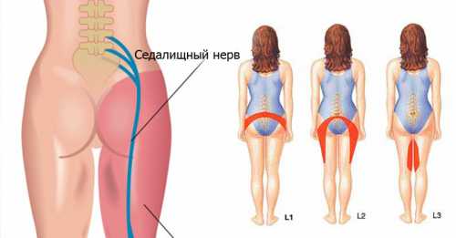 Как болит седалищный нерв, где и с какой стороны