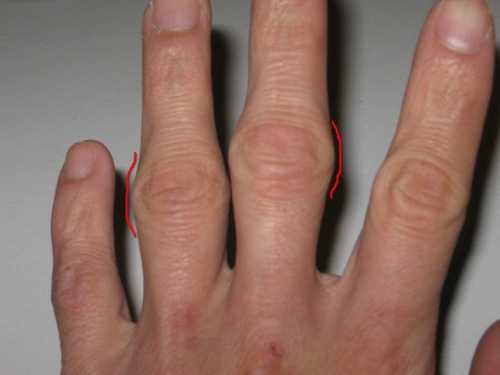 Болят суставы пальцев рук