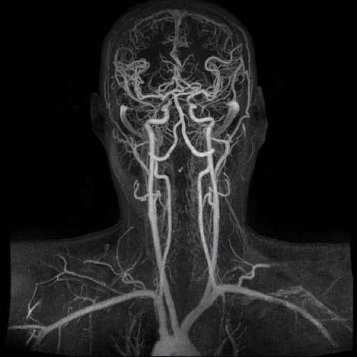 Ангиография сосудов головного мозга