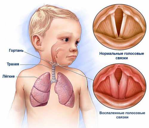 Ларинготрахеит у детей