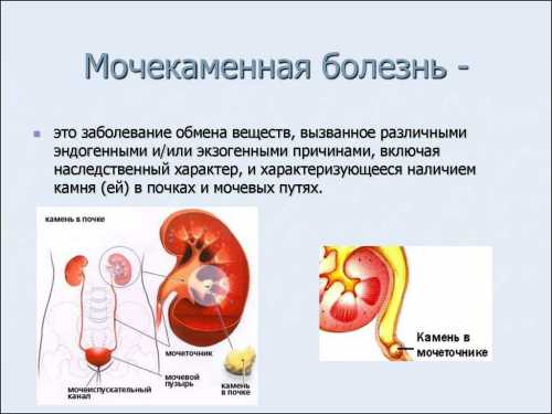 Мочекаменная болезнь у женщин: симптомы, причины,