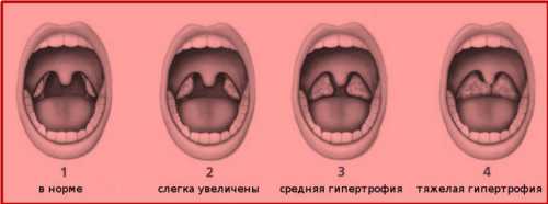 Аденоидит у детей