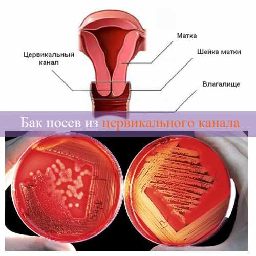 Во время исследования также можно определить концентрацию полезных микроорганизмов, которые могут жить в цервикальном канале