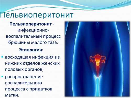 Женские воспалительные заболевания